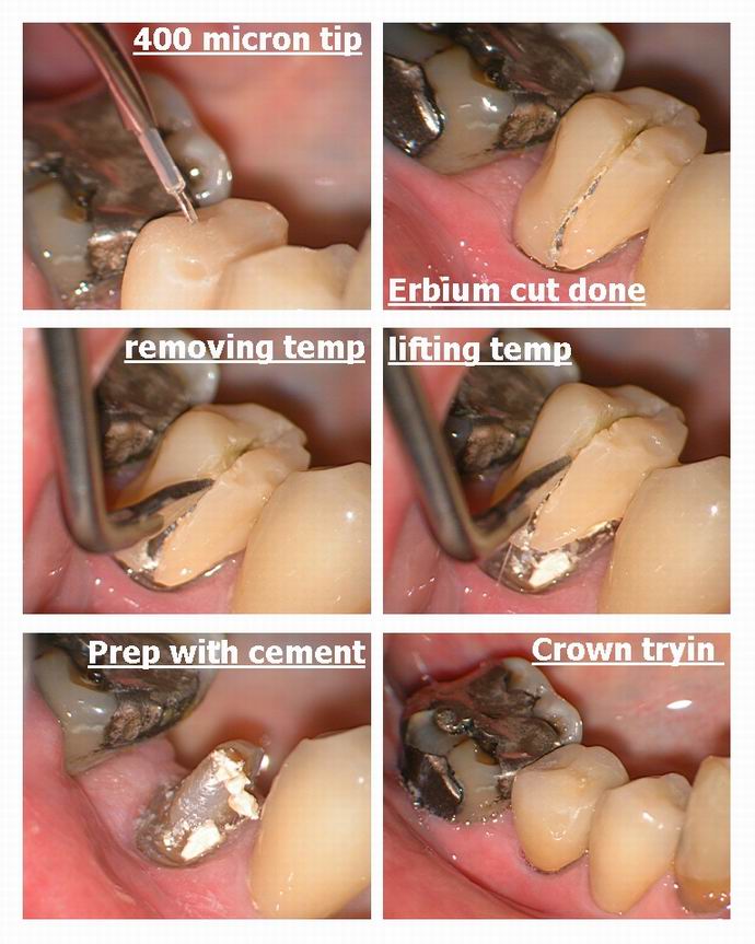 Resize of Removal of Temp crown.jpg